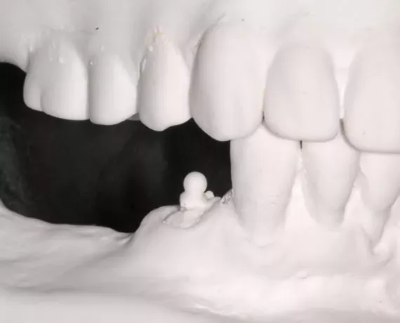 Klammerfreie Hybridprothese – ästhetischer und komfortabler Zahnersatz ohne sichtbare Halteklammern in der ACC Zahnklinik Basel