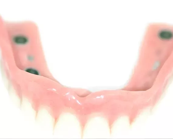 Klammerfreie Hybridprothese – ästhetischer und komfortabler Zahnersatz ohne sichtbare Halteklammern in der ACC Zahnklinik Basel