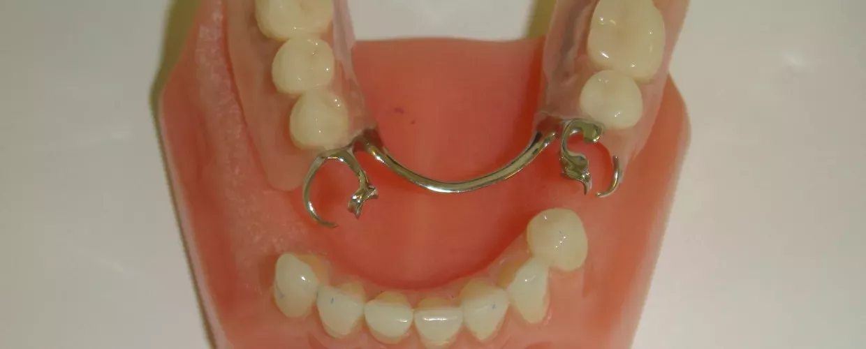 Teilprothese – herausnehmbarer Zahnersatz zur Wiederherstellung der Kaufunktion in der ACC Zahnklinik Basel