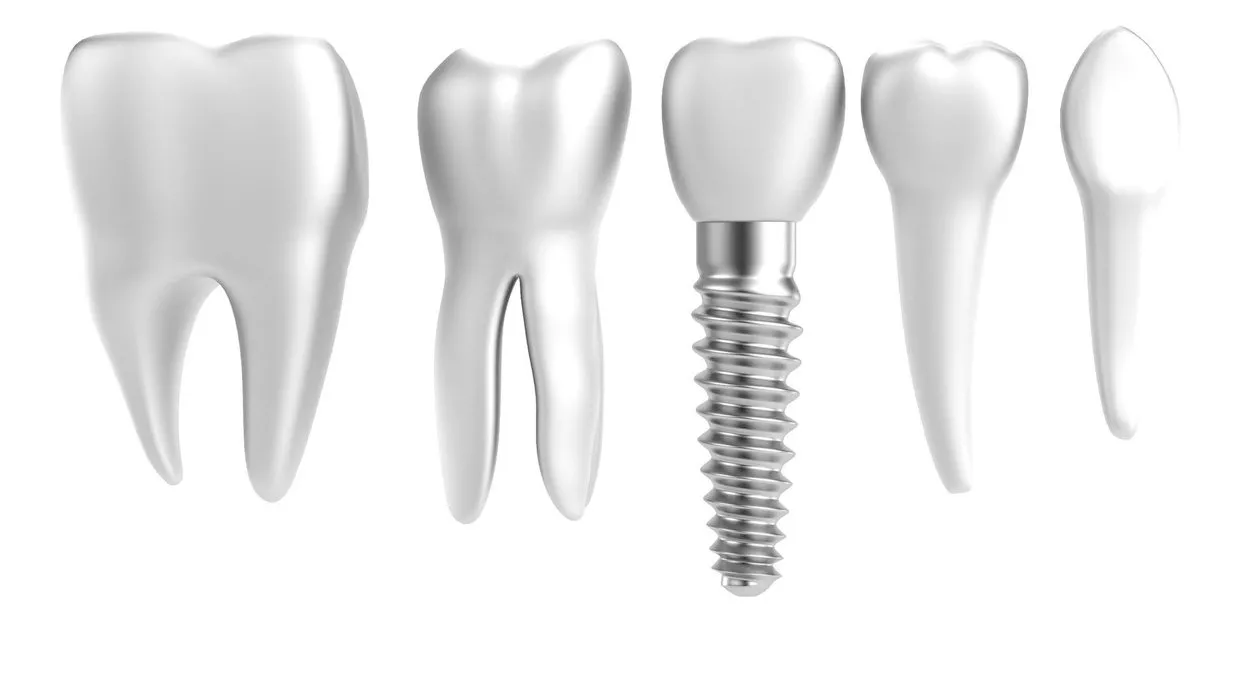 Zahnimplantat als dauerhafte und ästhetische Lösung für fehlende Zähne in der ACC Zahnklinik Basel