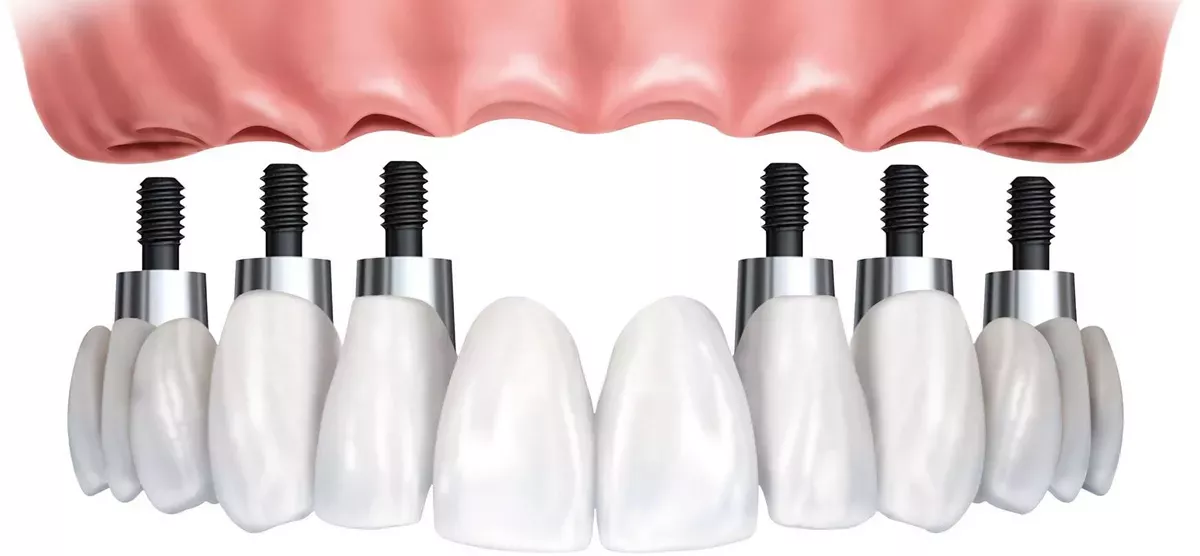 Zahnkrone – passgenauer, ästhetischer Zahnersatz zum Schutz und zur Wiederherstellung beschädigter Zähne in der ACC Zahnklinik Basel