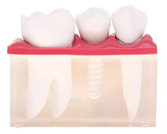 Zirkonimplantat – metallfreie, biokompatible Implantatlösung für natürliches Lächeln in der ACC Zahnklinik Basel